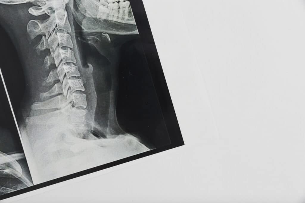 Skolioza u dorosłych – diagnostyka